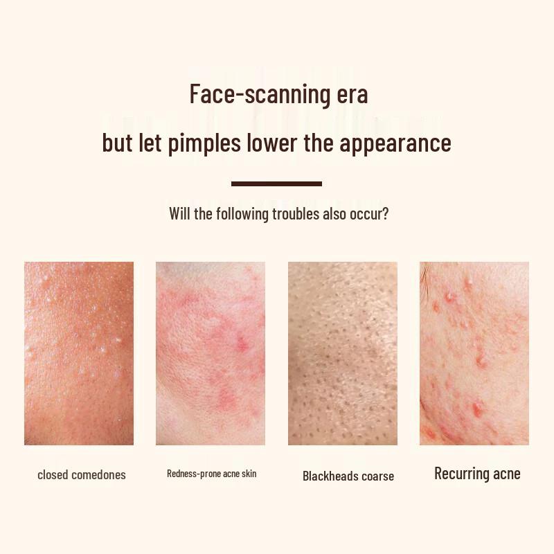 Lao Zhong Yi Acne & Blemish Treatment Kits