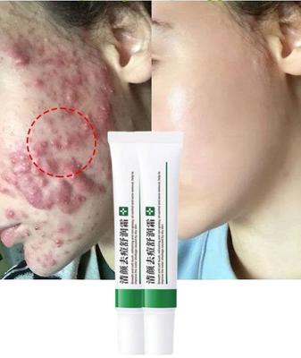 Akne Entfernung Creme Sommersprossen Creme Schrumpfen Poren Bleaching Feuchtigkeitsspendende Öl Kontrolle Akne Creme Hautpflege Akne Behandlung Gesichts Creme