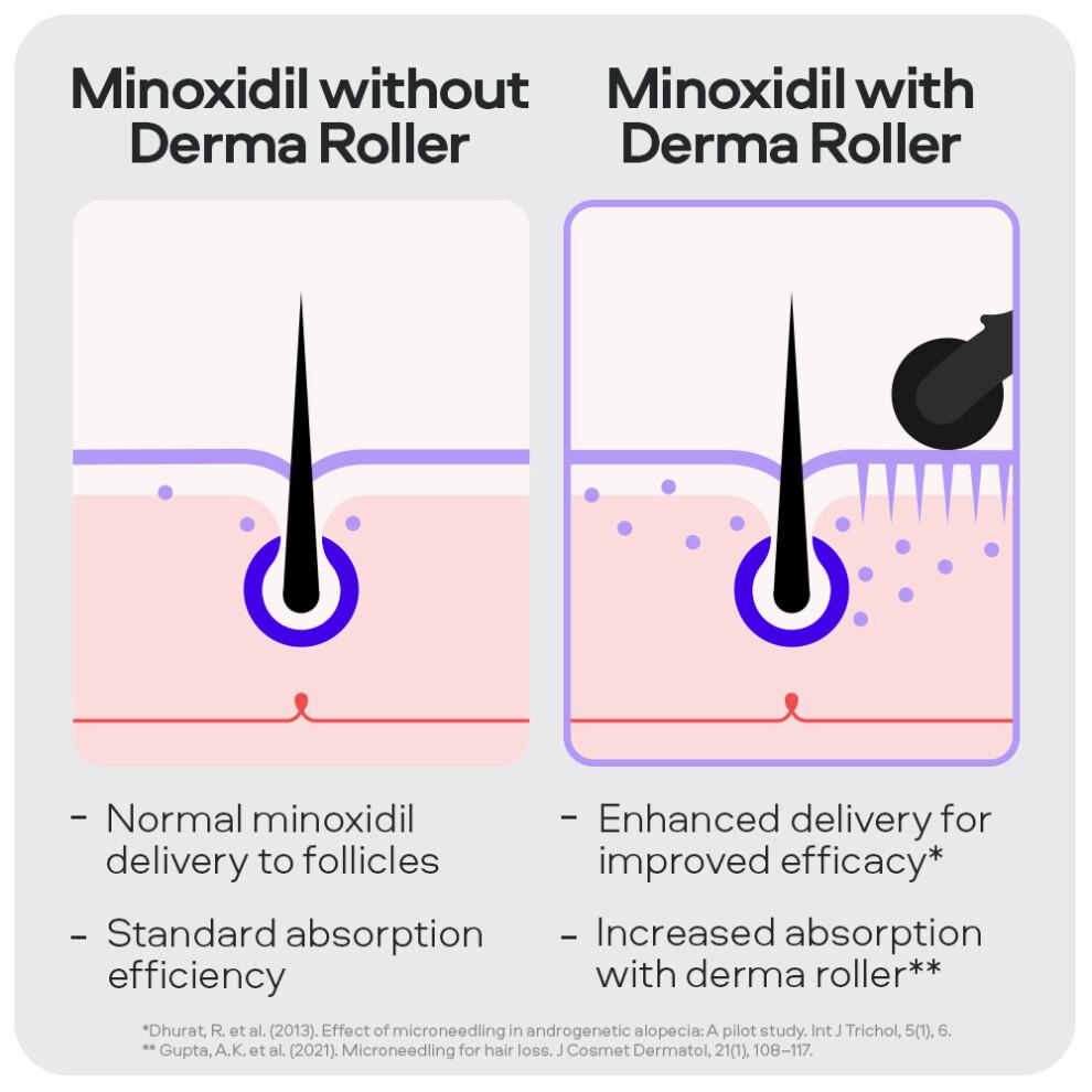Sons Minoxidil 5% e Derma Roller, 3 Mesi