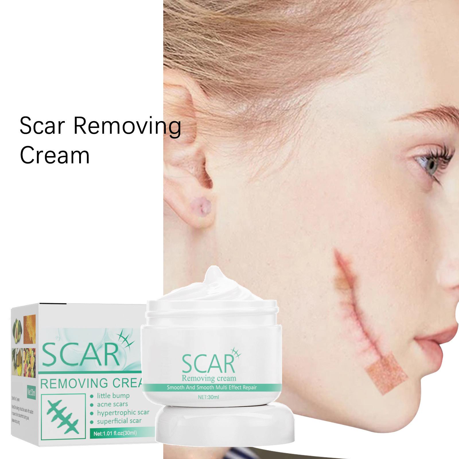 

30 мл разглаживающий крем для шрамов, осветляет и удаляет ожоги со старых шрамов, восстанавливающий крем для кожи после шрамов