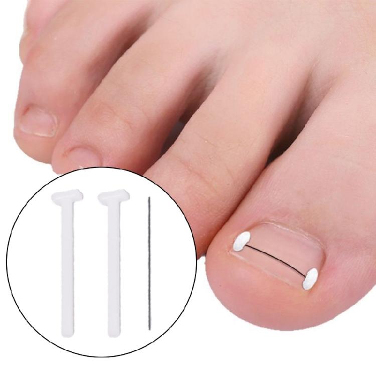 Titaniums Alloy Ingrown Toenail Treatments Ingrown Toenail Removal Kit Ingrown Toenail Corrector,Nail Correction Tools