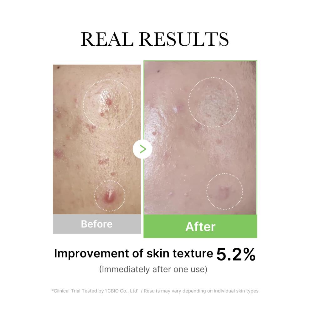 Medicube Exosome Cica Tea Tree Ampoule for Sensitive Skin with Centella Asiatica - Helps Reduce Redness and Breakouts | Low-Irrita