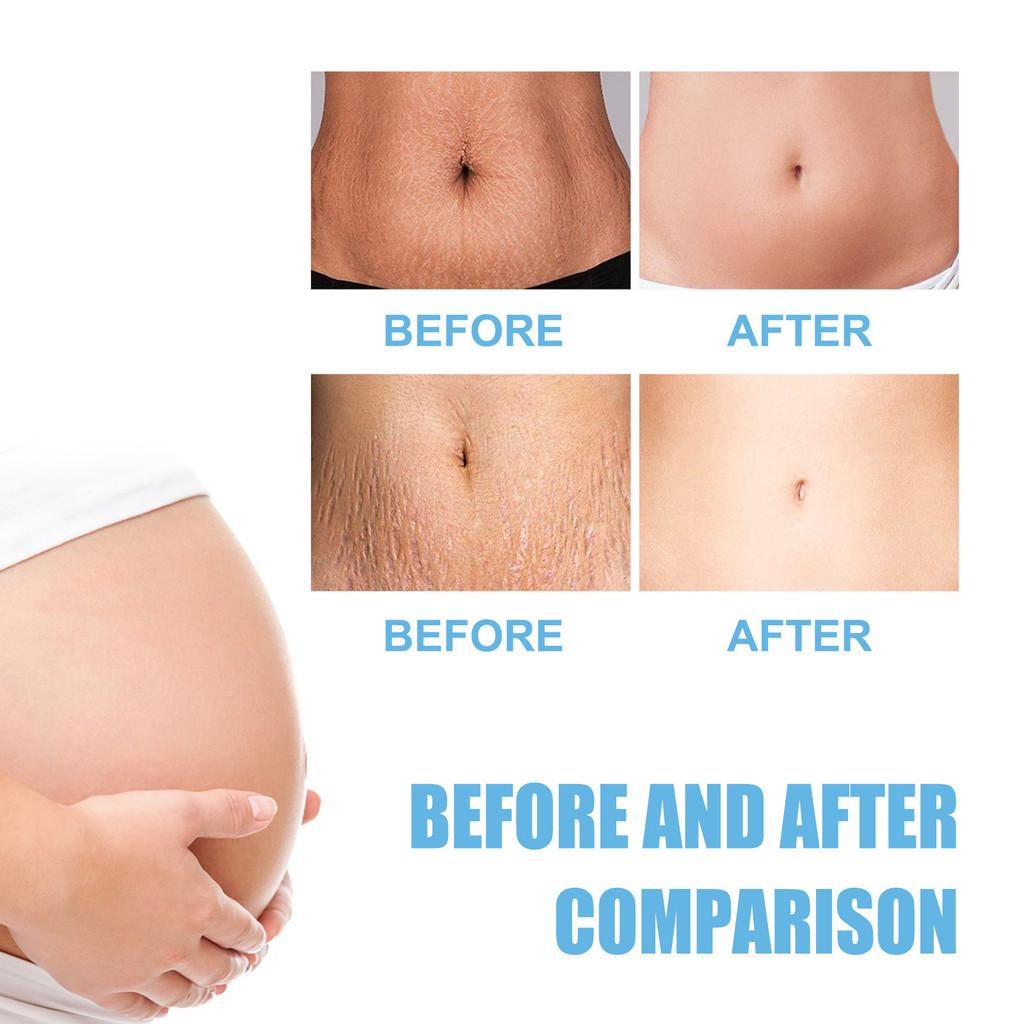 Eelhoe Stretch Mark Care Cream For Nourishing Skin With Collagen Firming Hydration