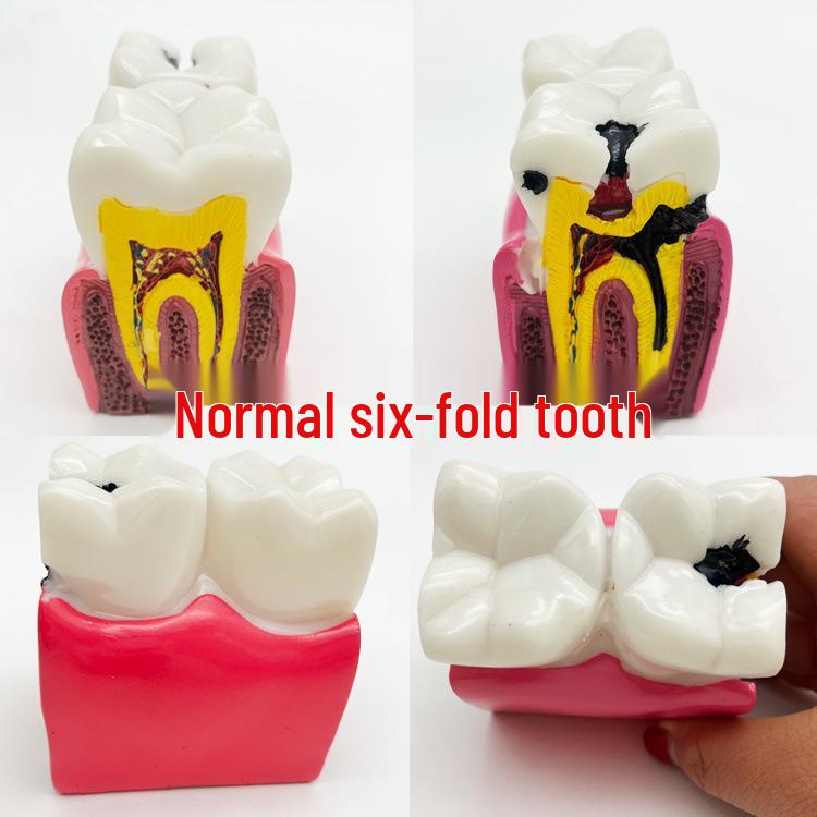 6x Caries Comparison Dental Model for Doctor-Patient Communication