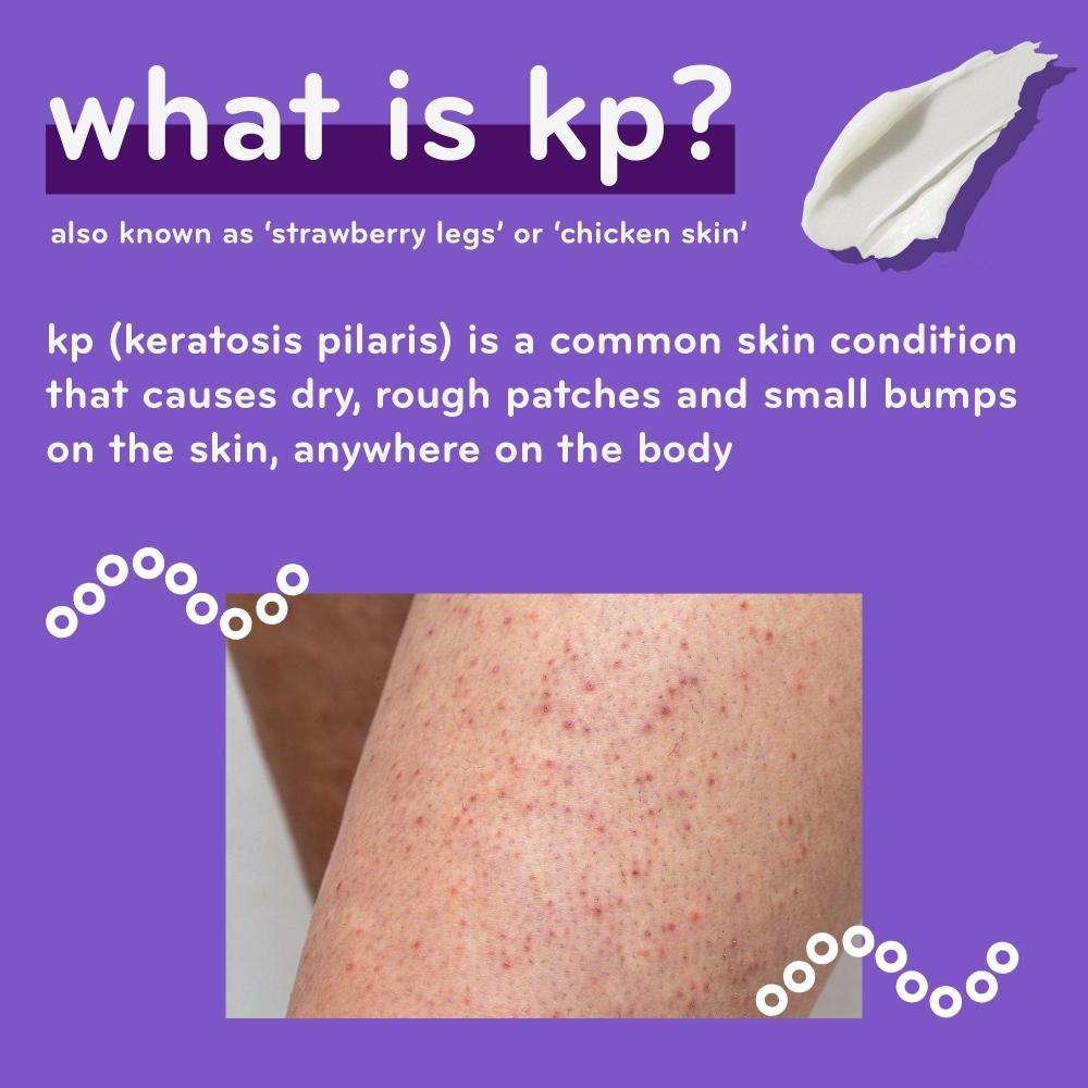 Amlactin Kp Bumps Be Gone Cream With 15  Lactic Acid Aha 3.0 Oz