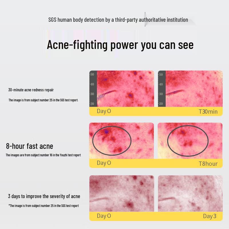 Yusu Acne Treatment Serum Set