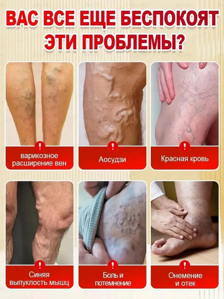 Petzoshenk German Varicose Veins Leg Veins Bulge Dilated Red Blood Cold Compress Gel