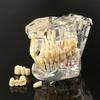 Modele Dentare Modele din Rășină Reparabile ale Dinților Bolnavi Pentru Predare și Cercetare în Medicină și Boli Dentare