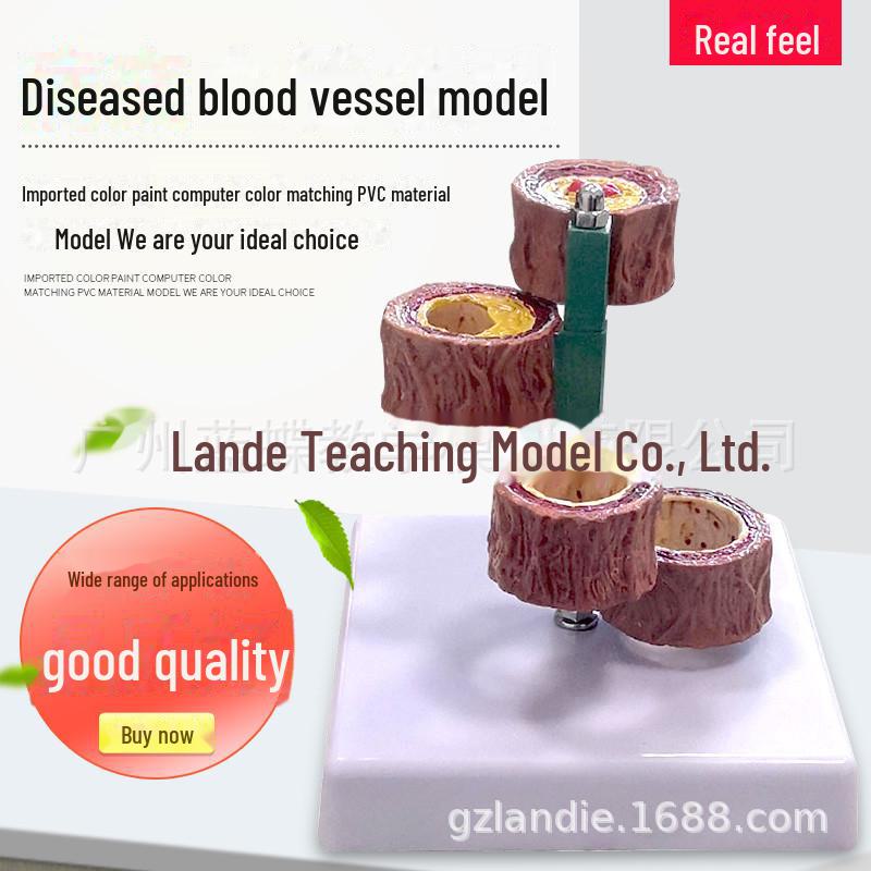 

Четырехстадийная модель сосудистого склероза и тромбоза