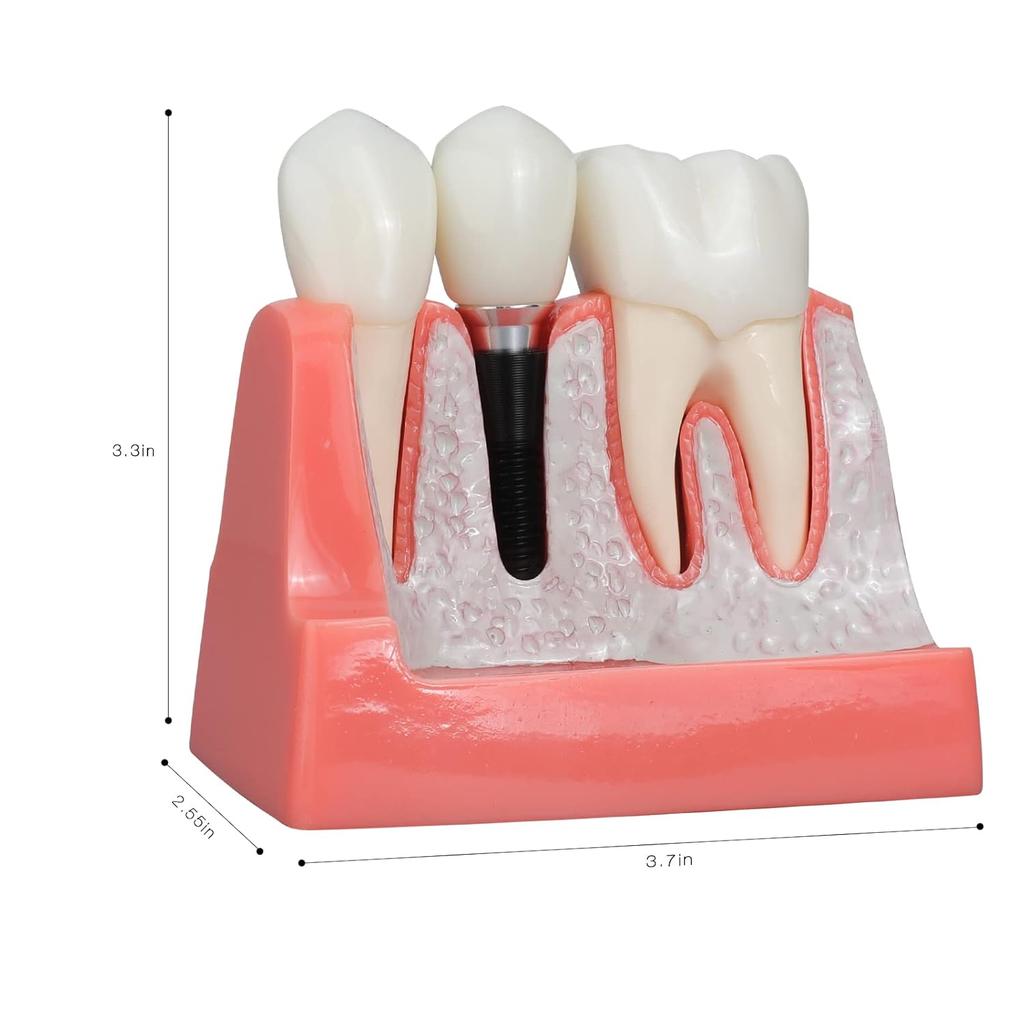 ANNWAN Dental Implant Model 4 Times Removable Analysis Crown Bridge Demonstration Teeth Model for Class Education and Studying Teeth Model