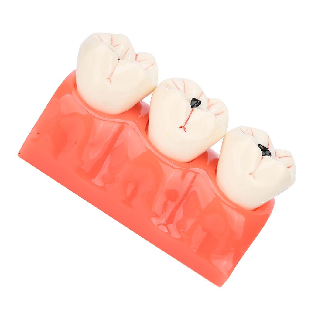 Dental Caries Model Tooth Decay Demonstration Model Simulation Detachable Teeth Model