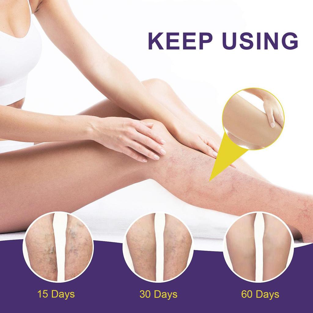 Varicose Veins Cream-Relief Phlebitis Angiitis-Promote Blood Circulation-Repair Skin Elasticity-Suitable For All Skin Types, 20g