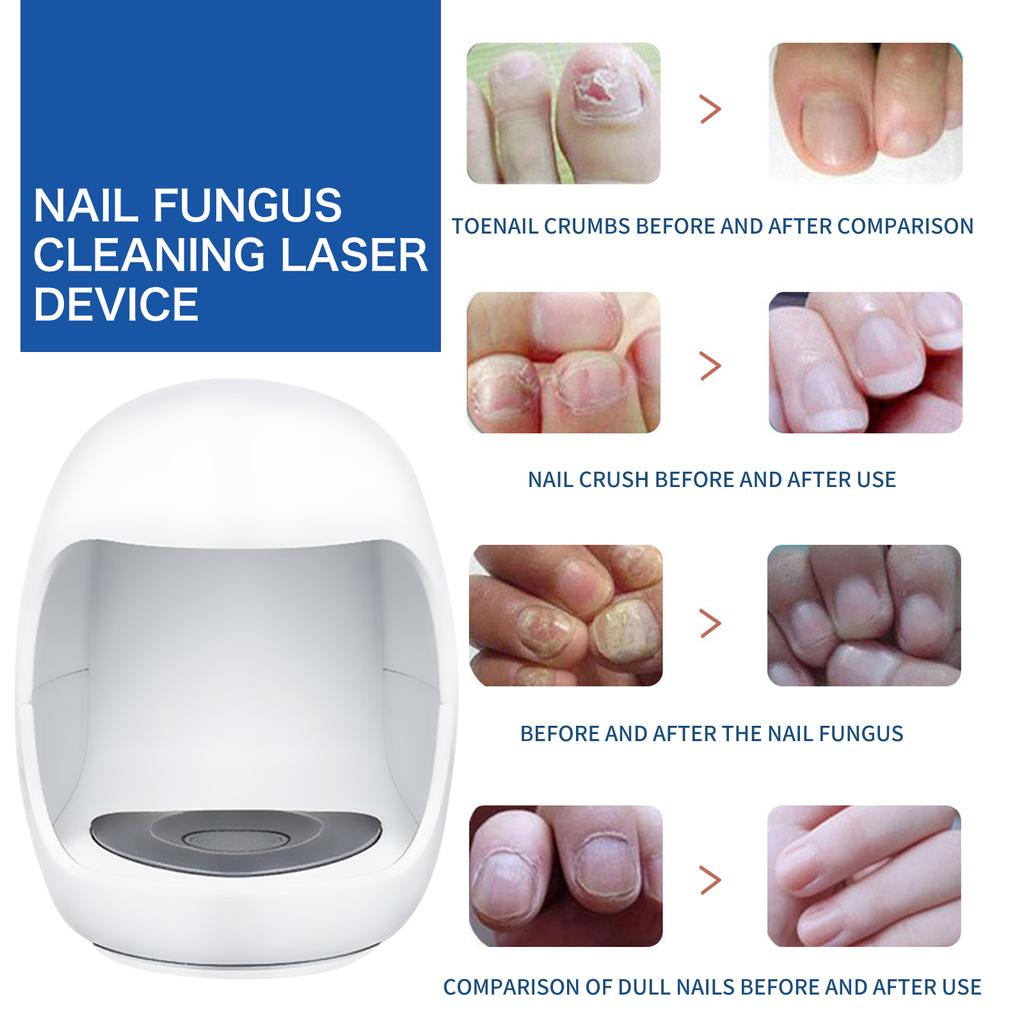 Nail Fungus Light Therapy Device Nail Fungus Treatment Lamp Nail Fungus Removal Device