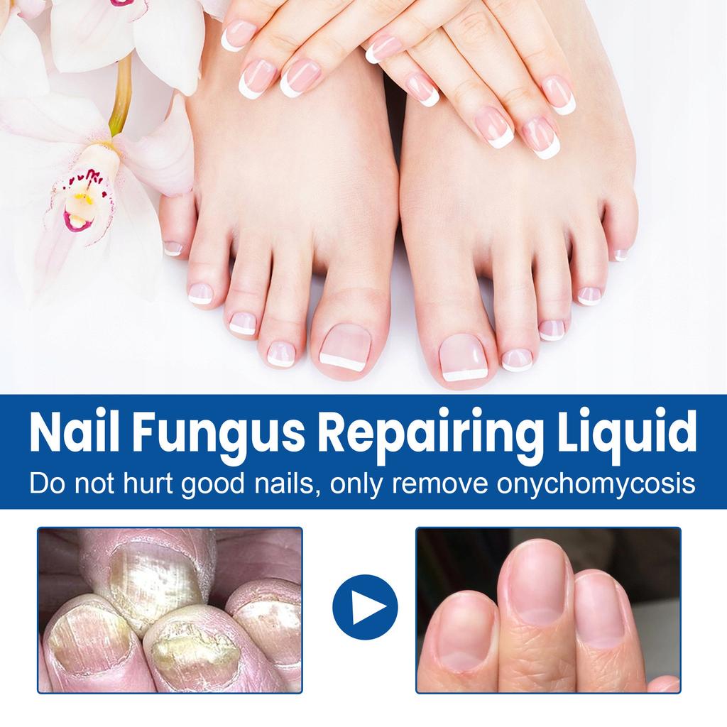 Onychomycosis Solution, Thickening Bright Onychomycosis Remover, Soft Onychomycosis, Hand And Foot Nail Care Solution 30ml