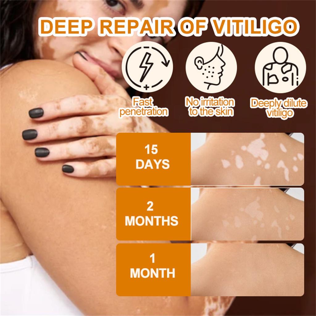 Krém na vitiligo, Přírodní zmírnění vitiliga pro kožní vitiligo, Krém pro péči o vitiligo, Redukuje bílé skvrny a zlepšuje pigmentaci kůže, Snadné použití