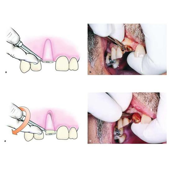 GDC Root Elevators Bein Standard (Eb2)