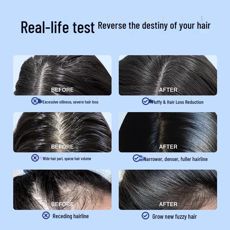 EHD Anti-Dandruff & Anti-Hair Loss Shampoo Set