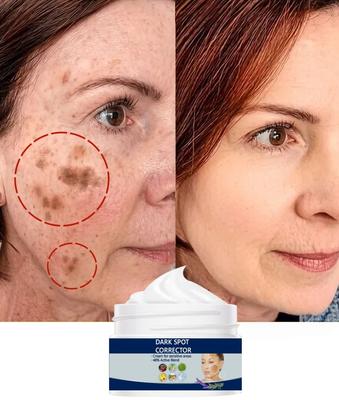 Whitening Freckle Cream Remove Melasma Cream Remove Dark Spots Anti Wrinkles Brighten Moisturizing Skin Care for Unisex
