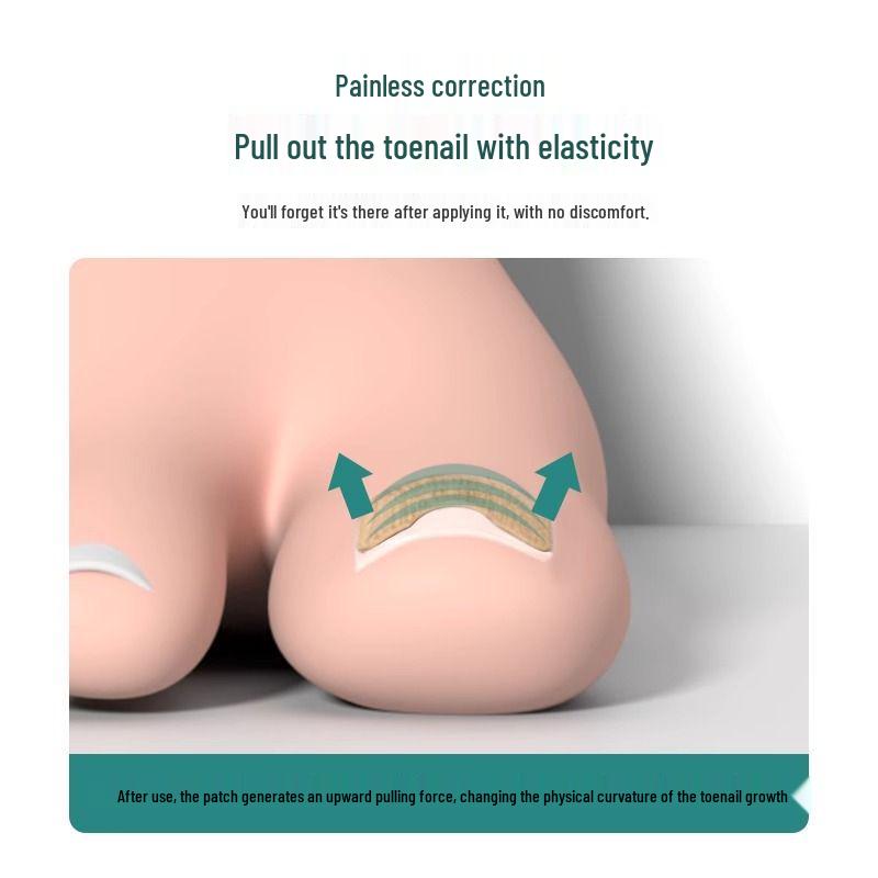 Glue-Free Press-On Toenail Stickers: Lala Nail Repair & Ingrown Correction Patches