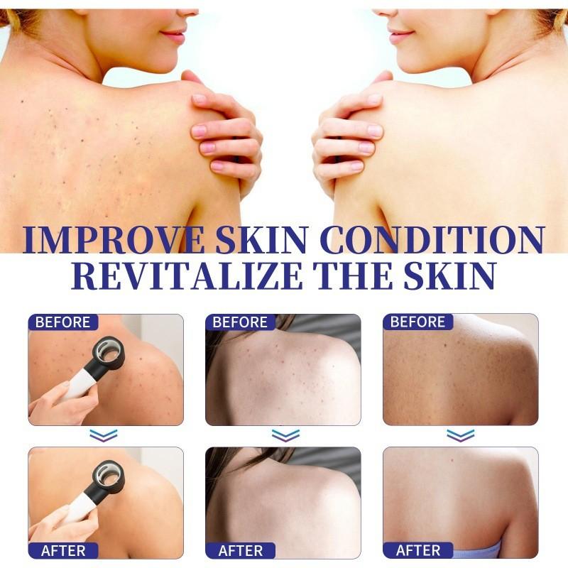 Jaysuing Back Care Spray For Fading Acne Marks And Smoothing Skin Texture