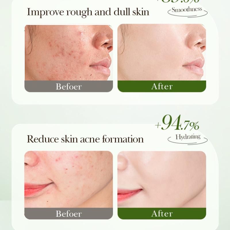 Salicylsäure Maske SADOER Akne Entfernung Beruhigend Verjüngend Feuchtigkeitsspendend Akne Entfernungsmaske