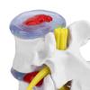 Anatomical Lumbar Disc Herniation Demonstration Model Human Spine School Training Supplies