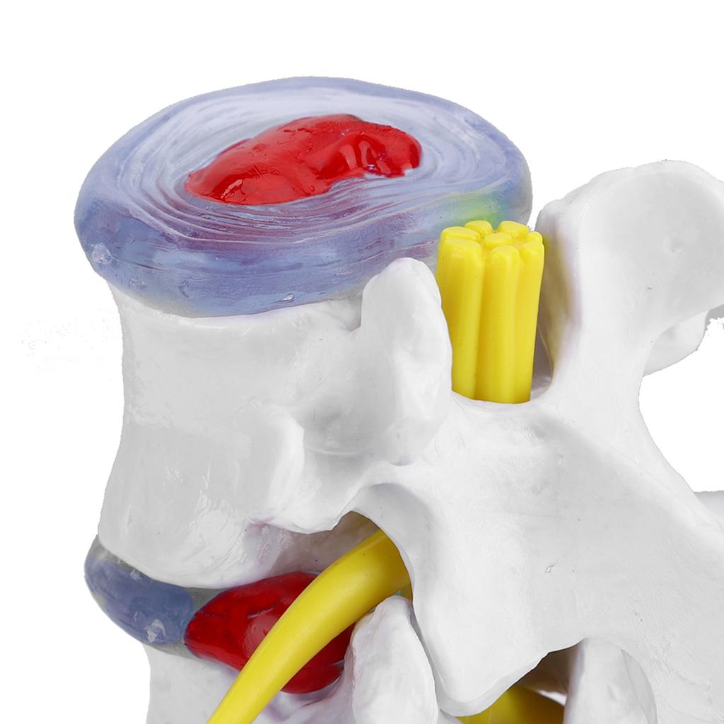 Anatomical Lumbar Disc Herniation Demonstration Model Human Spine School Training Supplies