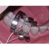 GDC Rubber Dam Clamp Adult 2a (Rdc2a)