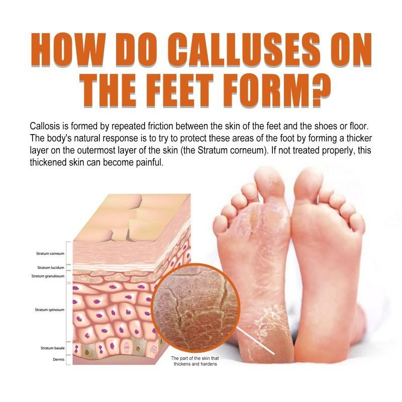 Nourishing Ouhoe Foot Spray For Softening Calluses And Cracked Heels 30ml