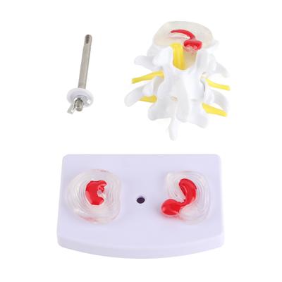 Anatomical Lumbar Disc Herniation Demonstration Model Human Spine School Training Supplies