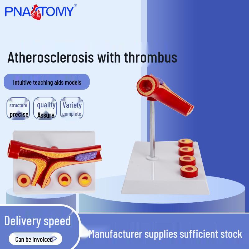 5-Part Artery Thrombosis and Atherosclerosis Model 16.5x13x17 cm