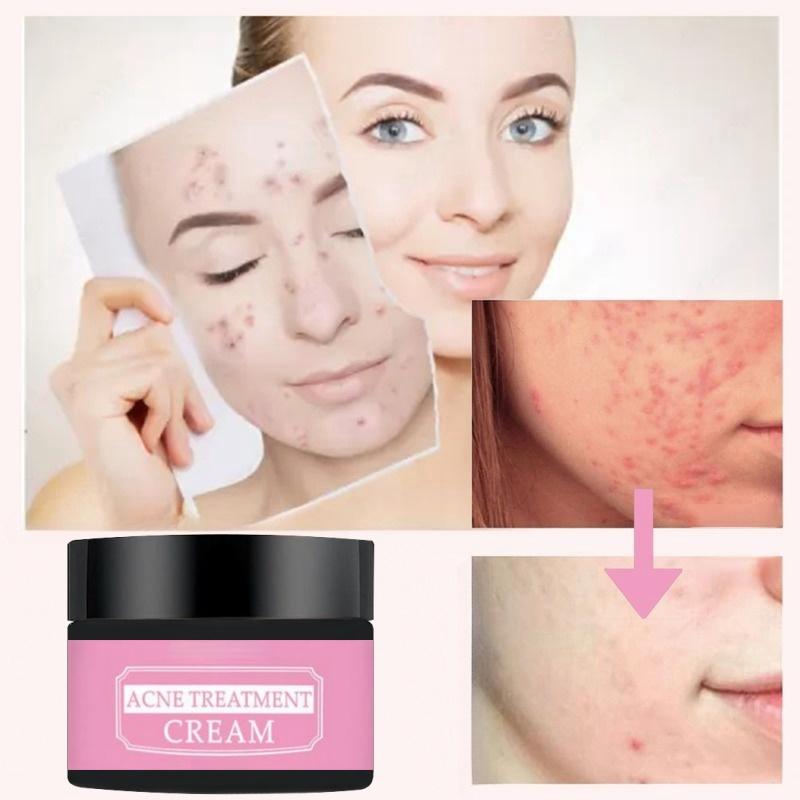 Remove Acne Mild Repair Acne Pits Acne Marks Nourishing Moisturizing Hydrating Acne Cream