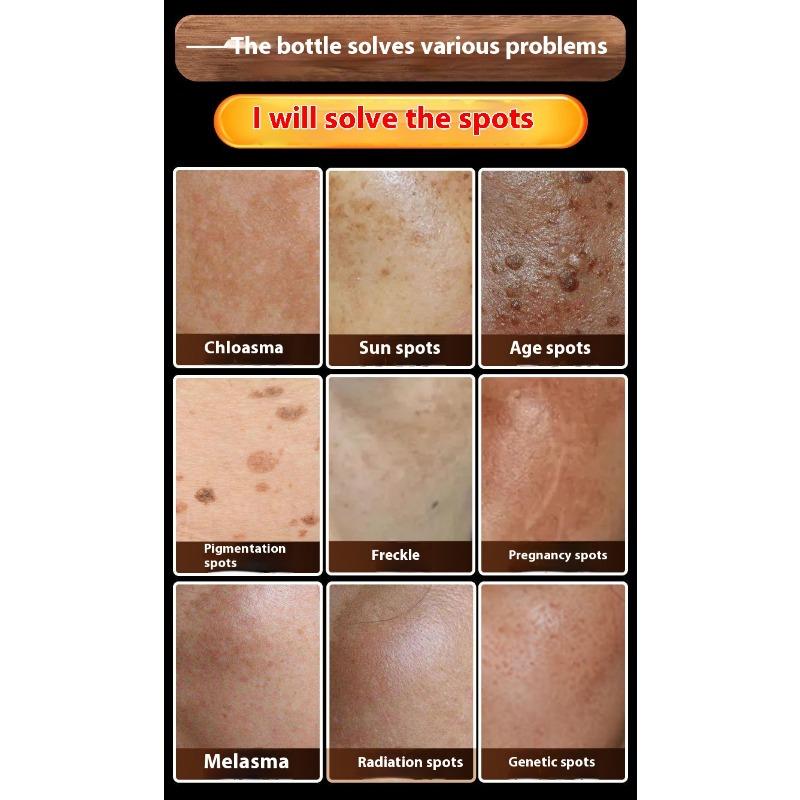 Whitening and Freckle Removing Cream Face Cream Lightening and Removing Spotles Sunburn Brightening Skin Color