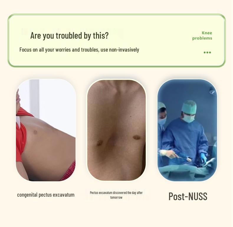 Korektor pectus excavatum střední hmotnosti s podtlakem pro korekci vkleslé hrudi a zlomeniny hrudní kosti