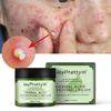 Cuidados de rosto – Remédios para acne