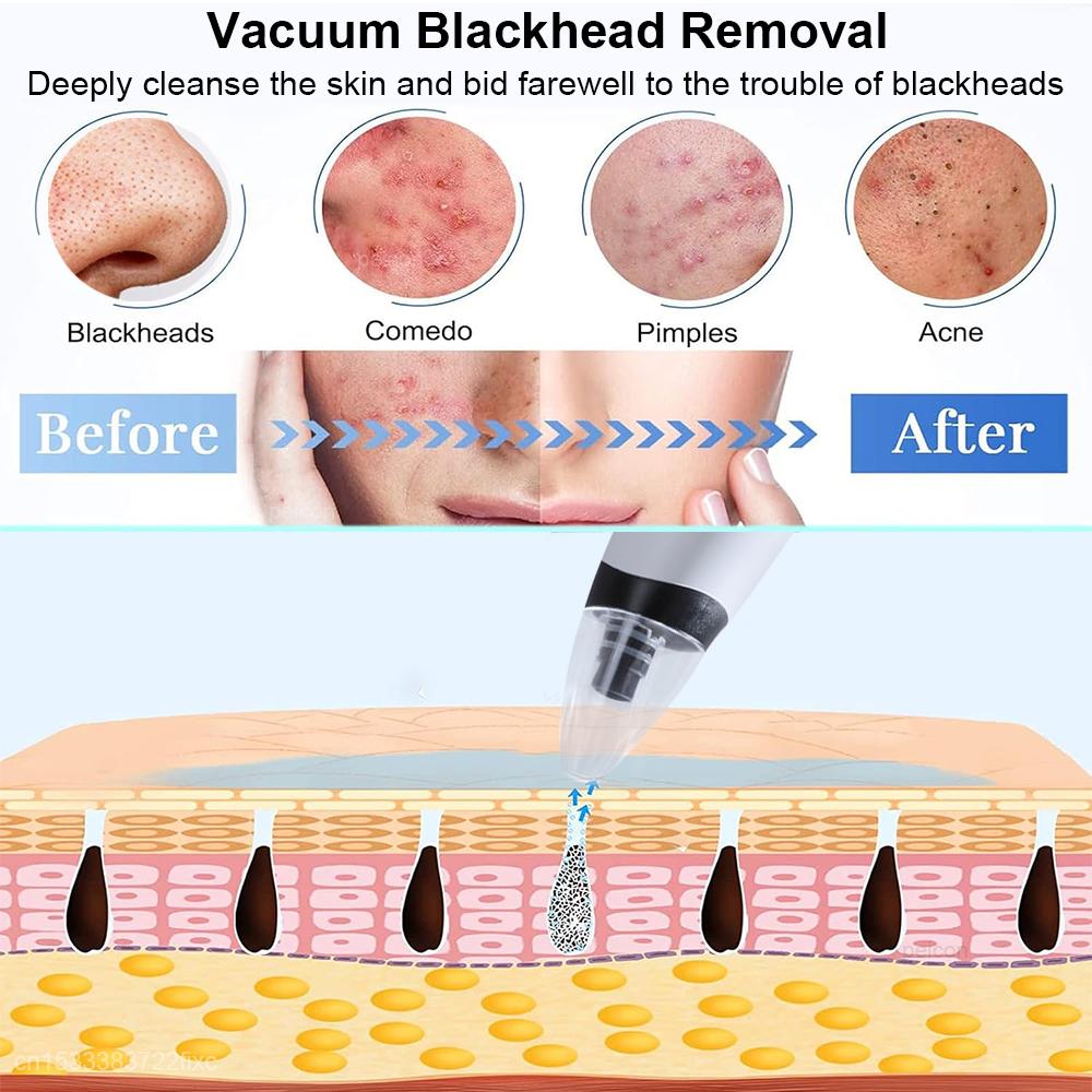 Blackhead Remover Pore Cleaner Black Dots Remover Electric Black Point Extractor Pimple Acne Blackhead Black Dots Vacuum Cleaner