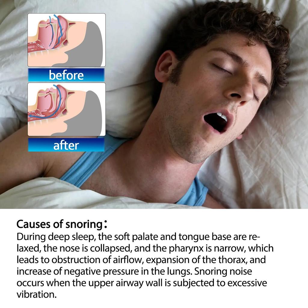 South Moon Nasal Strips Anti-snoring and Snoring Products Sleep Care Dilatation Nasal Strips