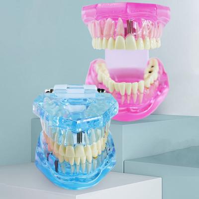 Dental Implant Model Teaching Aid for Dentist Student School Removable Teeth Orthodontic Demo