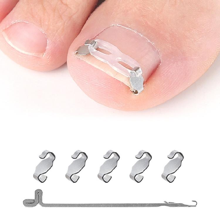 Stainless Steel Lever Hook Ingrowns Toenail Tool Elastic Bands Adjustable Corrector For Men And Women