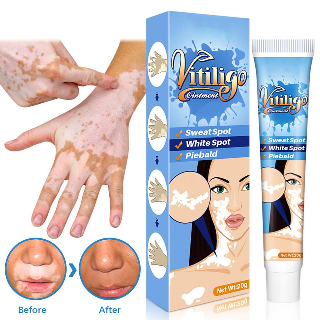 Vitiligo-Creme, natürliche Vitiligo-Linderung der Haut, Vitiligo-Pflegecreme, reduziert weiße Flecken, verbessert die Hautpigmentierung
