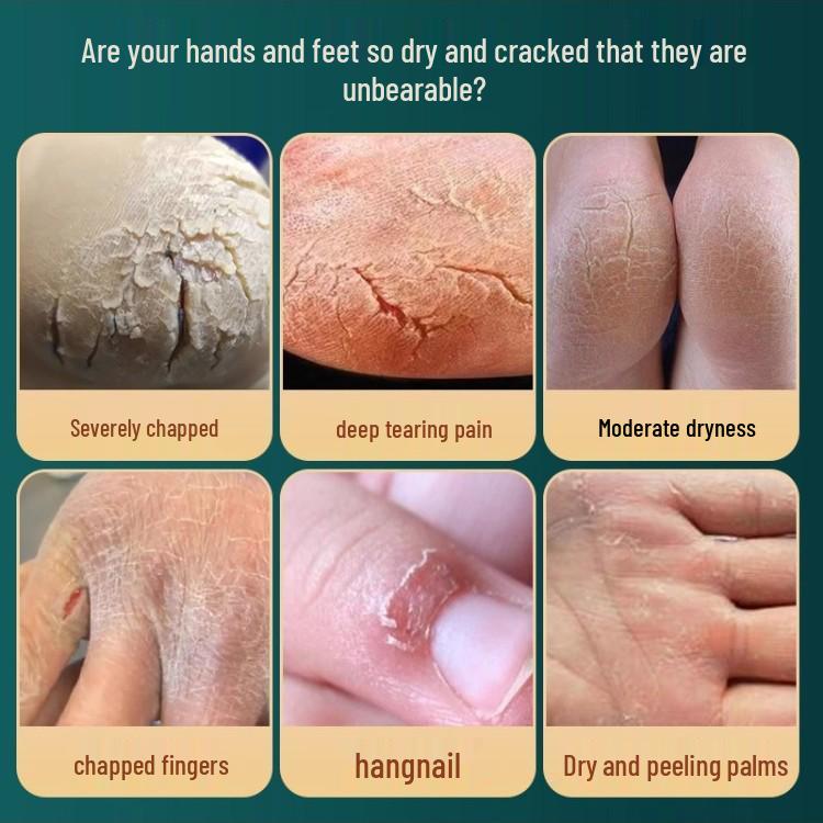 

Крем для восстановления пяток и стоп с лошадиным жиром - против трещин, увлажняющий для потрескавшейся кожи Horse Oil - 1 Box