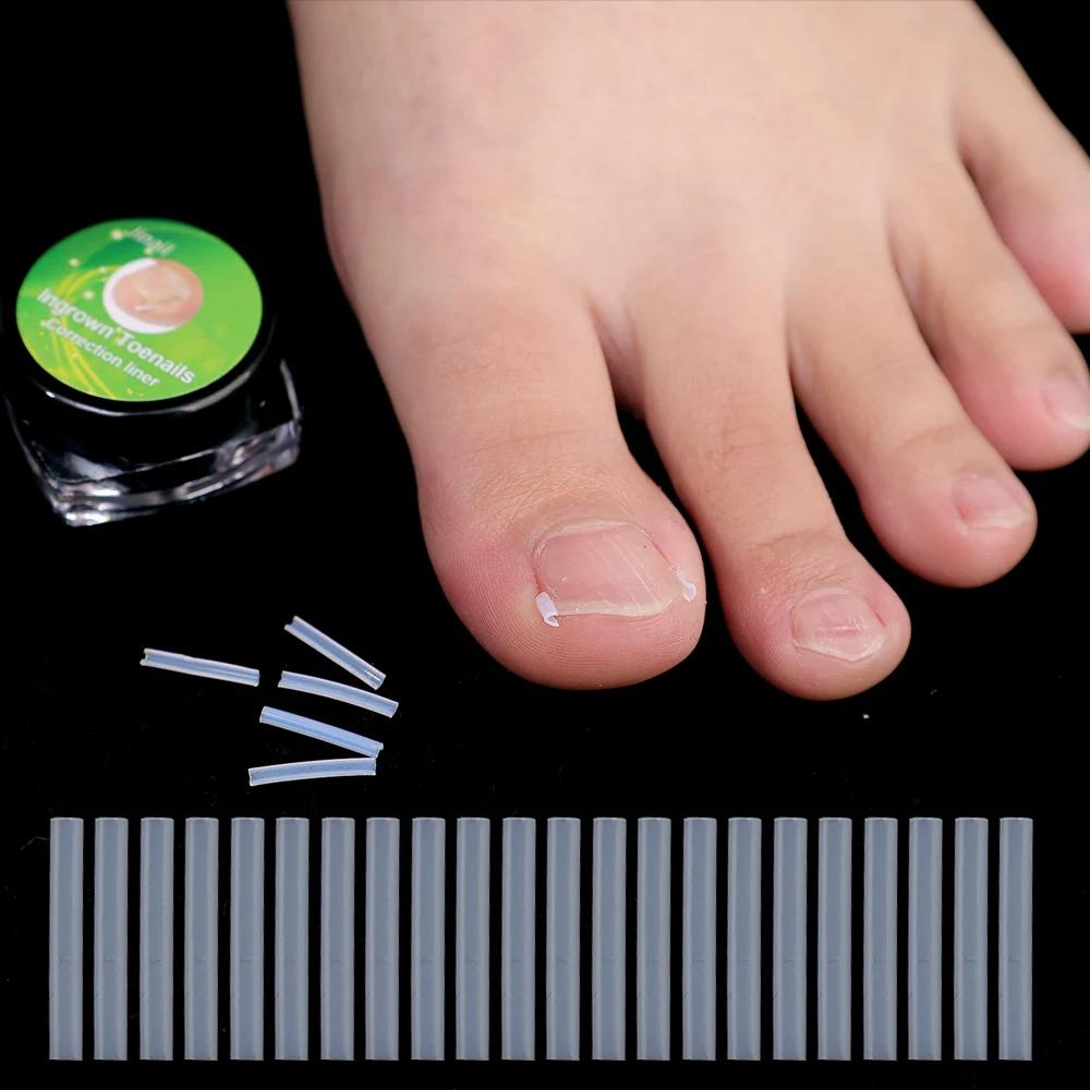 Ultra-thin Ingrown Toenail Corrector Tools C-shaped Tube Pad Correcting Nails Growth Paronychia Treatment Recover Pedicure Tools