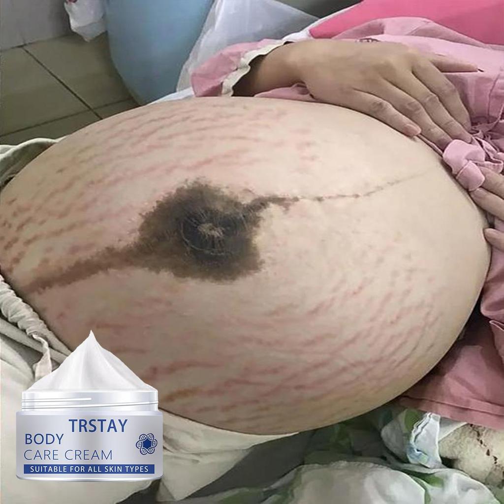 Pregnancy Repair Cream Stretch Mark Removal Removal Acne Scar Stretch Marks Cream Fat Striae Gravidarum Treatment Body Creams