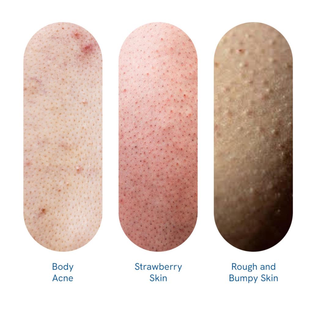 Be Bodywise 1% Salicylic Acid Body Wash 700ml | Prevents Body Acne, Bumpy skin, Suitable for all skin types | Body Shower Gel