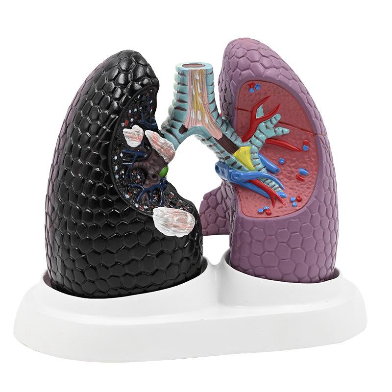 Human Lung Model: Healthy vs. Smoking Lesion for Respiratory Teaching