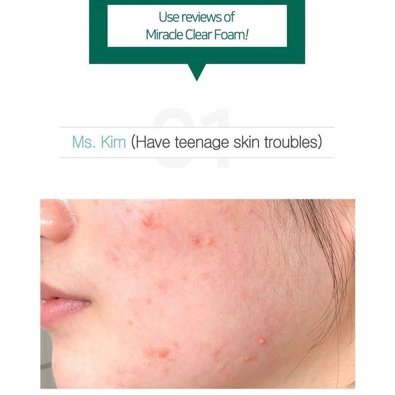 SOME BY MI - AHA,BHA,PHA 30 Days Miracle Acne Clear Foam Mini