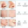 Xiaomi Deep-cleaning Silicone Handheld Blackhead Remover with Vacuum Suction Power, Capable of Cleaning Pores and Removing Acne.