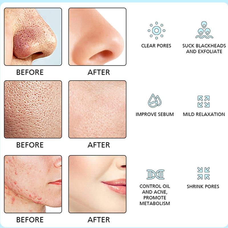 Xiaomi Deep-cleaning Silicone Handheld Blackhead Remover with Vacuum Suction Power, Capable of Cleaning Pores and Removing Acne.