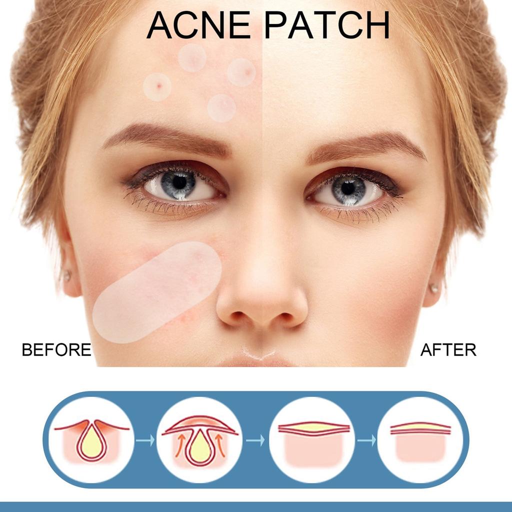 80Pcs/Set Acne Patches With Oil Ultra Thin Pimple Patch Acne Patch