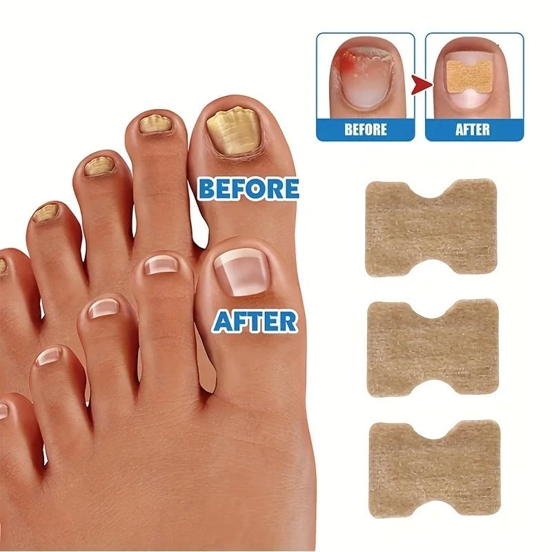 20Pcs Nail Correction Stickers Ingrown Toenail Corrector Patches Paronychia Treatment Recover Corrector Pedicure Tools